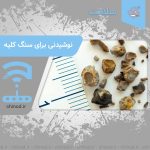 نوشیدنی های موثر بر سنگ کلیه Kidney stones چینود chinod